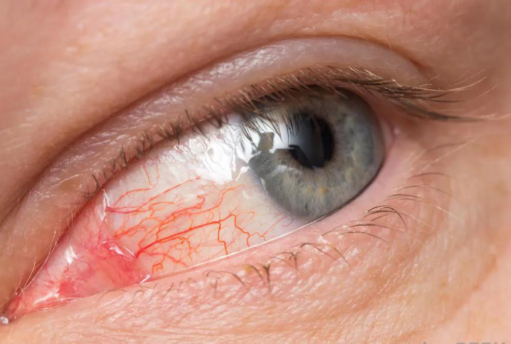 疫情期间眼睛红肿怎么缓解,疫情期间眼睛有问题可以去医院吗