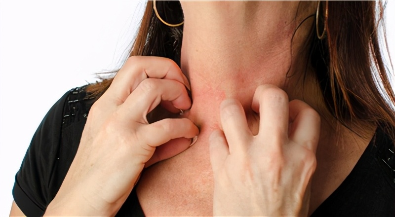 挠痒快速止痒妙招,夏季过敏性皮炎痒了能挠吗