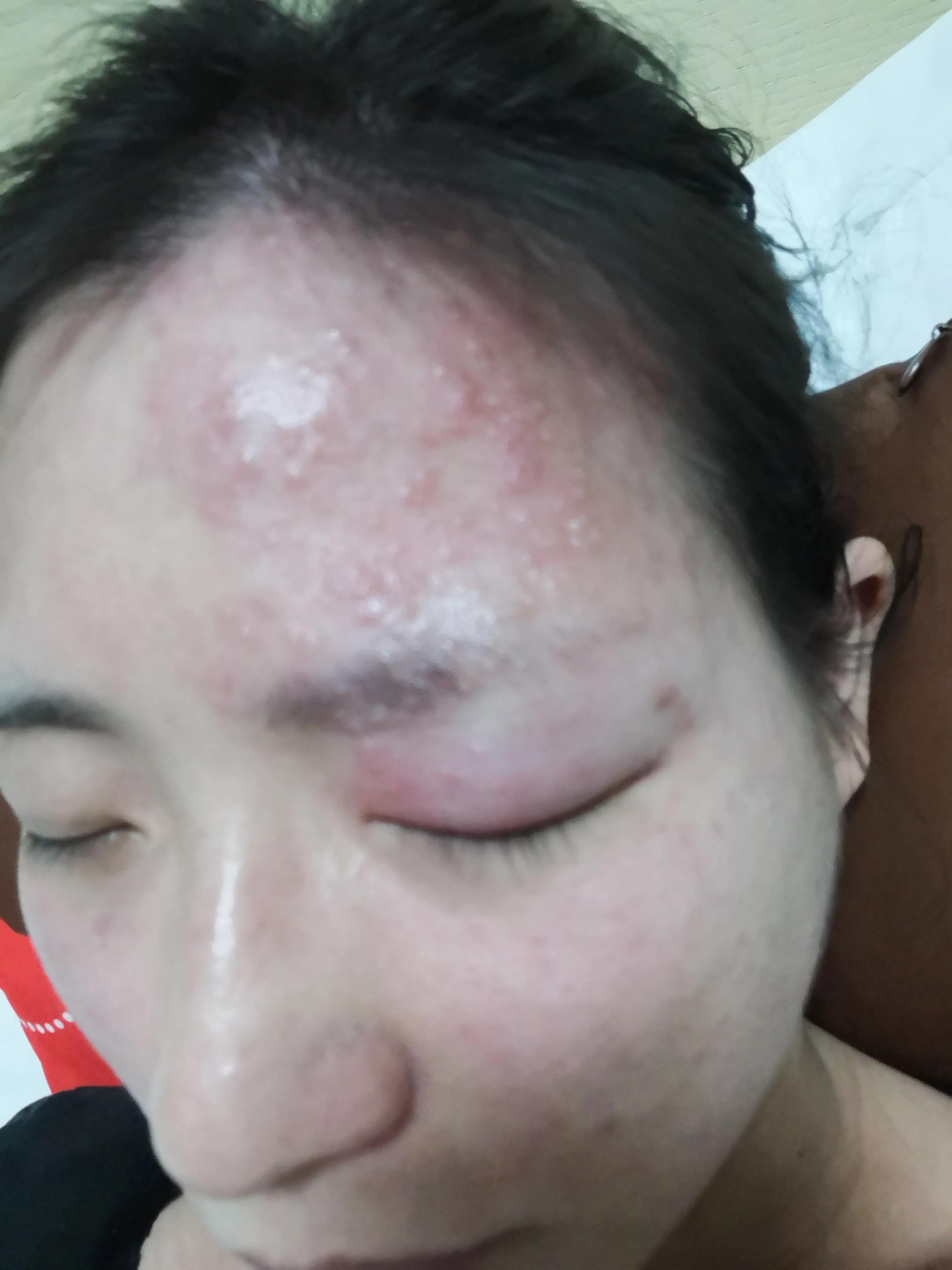 孕妇得了带状疱疹病毒怎么办,孕中期得带状疱疹该怎么办