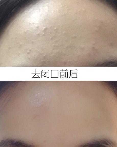 女生闭口痘痘怎么处理好得快,女生脸上有闭口痘痘怎么解决