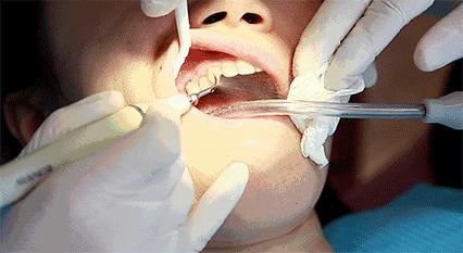 牙蛀了要补吗,牙齿蛀了一点需要补牙吗