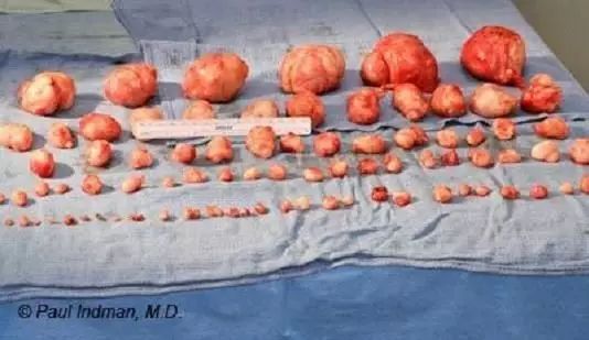 这个方子和穴位，专调肌瘤与囊肿，可惜知道的人太少了