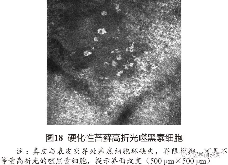 炎症性皮肤病反射式共聚焦显微镜诊断特征专家共识全文发布