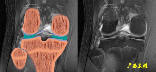 交叉韧带损伤的mr表现,后交叉韧带损伤的诊断实验