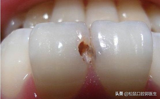 怎样判断自己有蛀牙,怎样判断自己有没有蛀牙