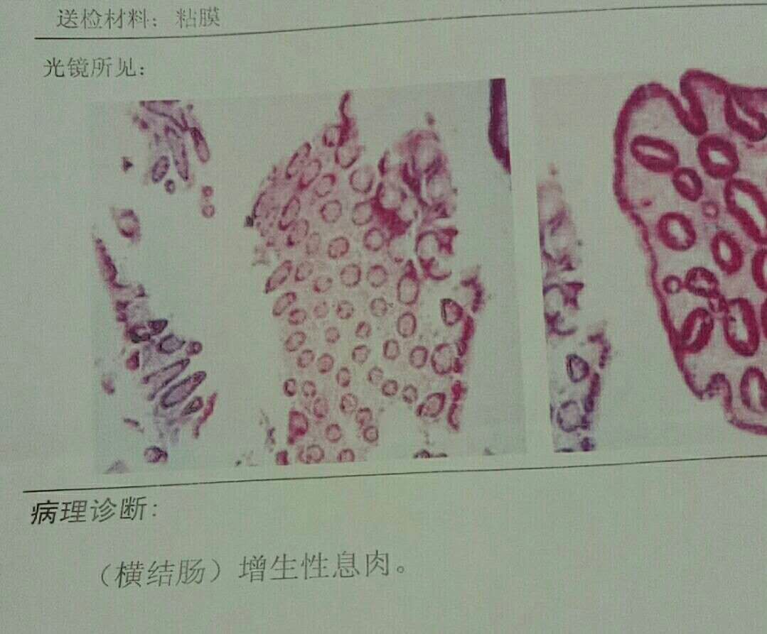 肠息肉发展为肠癌大约多久,肠息肉到肠癌要经过几个阶段