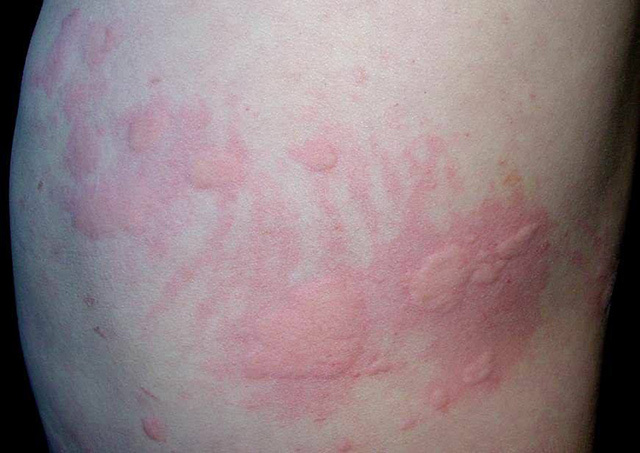 *麻疹荨**的自救处理方法