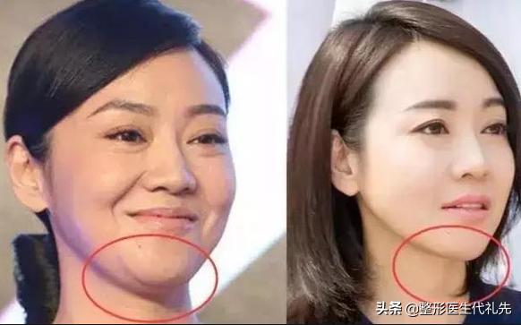 快来看看你的脸为什么会越变越宽,哪些可能会影响脸越来越宽