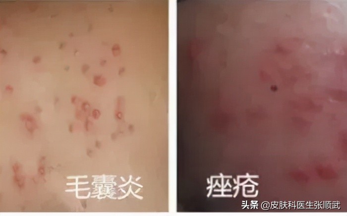 毛囊炎起大疙瘩里面流脓,毛囊炎肿大有脓怎么治