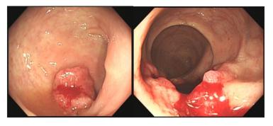直肠癌同时肝转移又肺转移怎么办,结直肠癌合并肝转移陷入困境