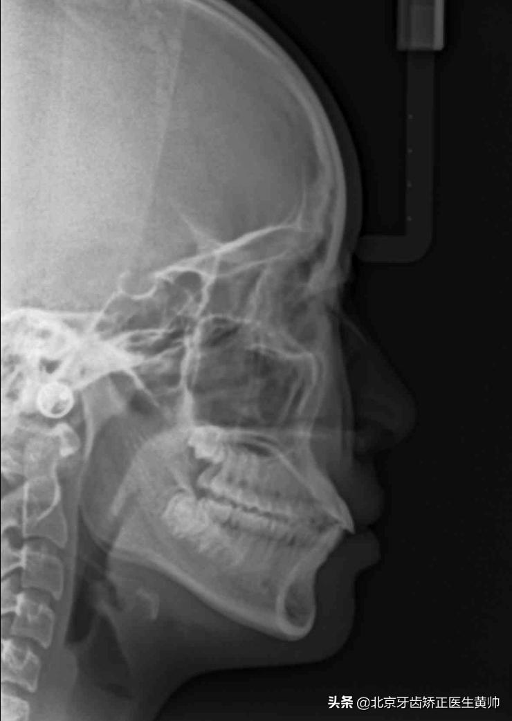 腺样体肥大牙齿矫正最佳年龄,儿童龅牙牙齿矫正最佳年龄