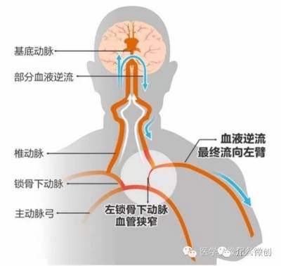 锁骨下动脉盗血综合征手术费用,锁骨下动脉盗血综合征中医怎么治