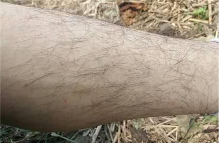 爱美女子如何能忍受自己多毛呢？“多毛症”的前世今生，请看此文