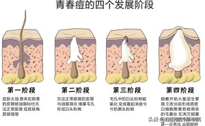 痘痘内分泌失调么,亚麻籽油治疗痘痘
