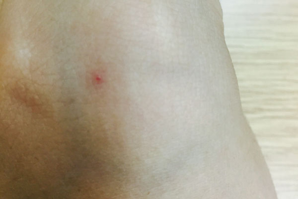 你身上长出好多小红痣是什么原因,身上手上长小红痣不痛不痒