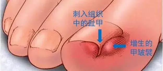 治疗甲沟炎真正有效的办法,甲沟炎指甲剪神器正品