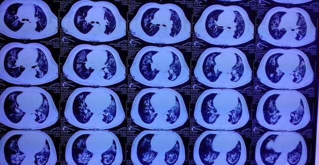 尿毒症并发症治疗,肾内科医生讲述的尿毒症患者