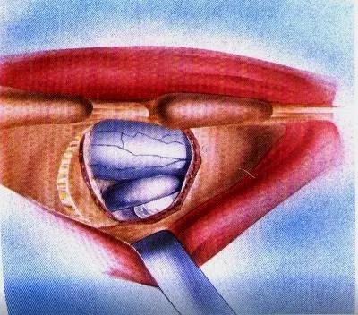 腰椎间盘突出该怎么选择手术方案,腰椎间盘突出症手术方式有哪些