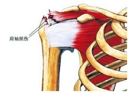 肩肌劳损怎么练肩,肩膀疼痛还能继续练肩嘛
