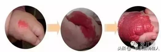 宝宝身上有点小红点,宝宝身上红色胎记但是不凸起