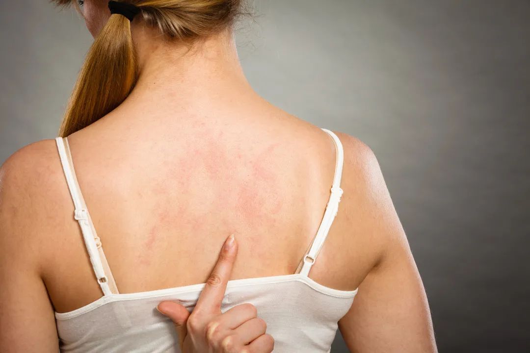 靶向药皮疹治疗多久会消失,服用靶向药起皮疹怎么办