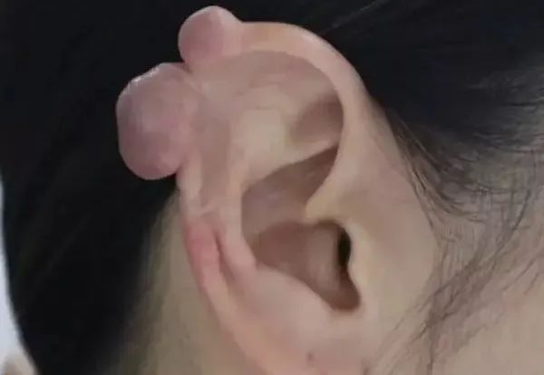 打耳洞打出个肉疙瘩,打耳洞长出肉疙瘩的概率多大