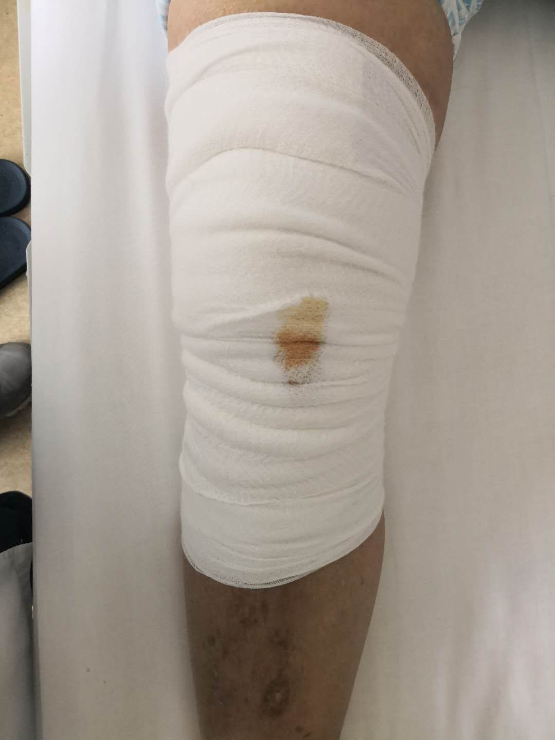 膝关节置换四十天应该怎样康复,膝关节置换术后两周内康复过程