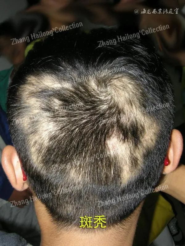 托法替尼治疗斑秃,斑蝥治疗斑秃配方