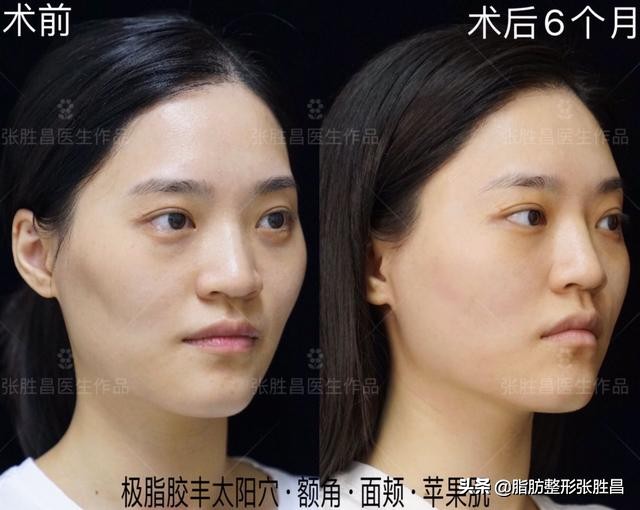 自体脂肪胶填充太阳穴泪沟法令纹,自体脂肪太阳穴填得太饱满了