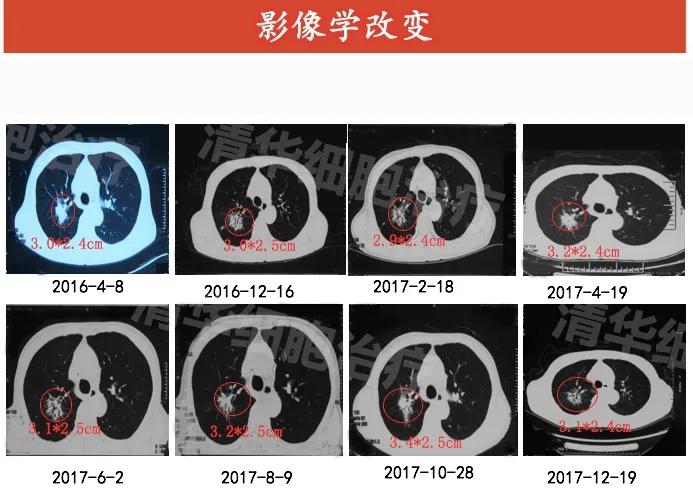 肺癌晚期活不了多久的症状,肺癌晚期生命只剩下六个月