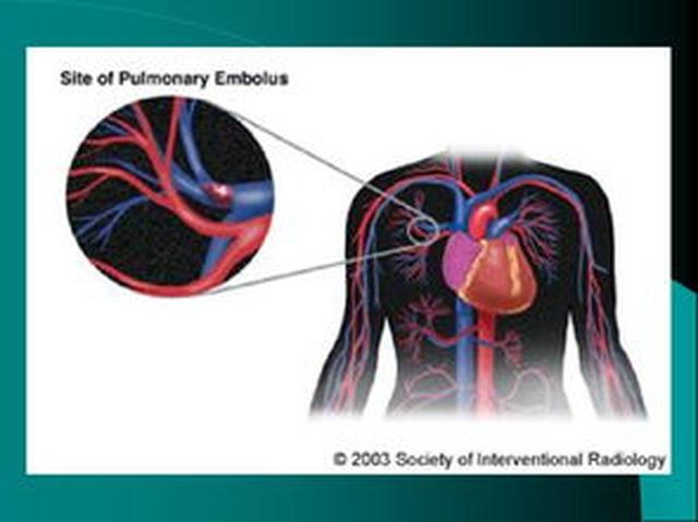年轻女孩崴脚后12天身亡,女孩崴脚了