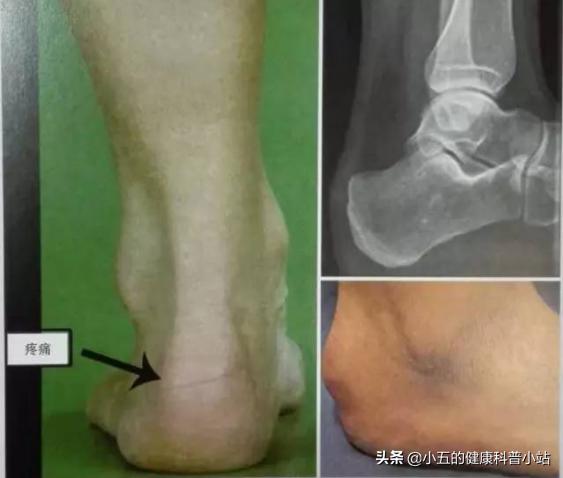 足跟痛的原因和治疗方法,足跟痛的快速解决办法