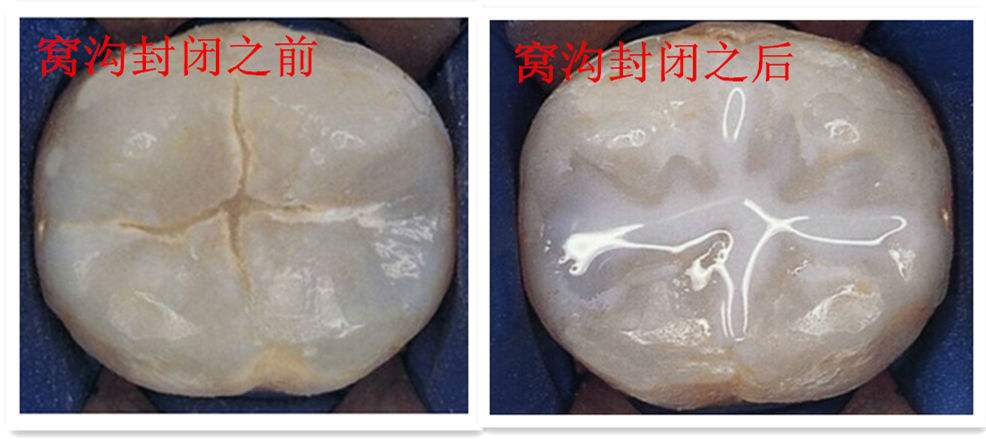 每天刷牙但是一直有蛀牙怎么预防,儿童牙齿蛀牙在长新牙齿怎么预防