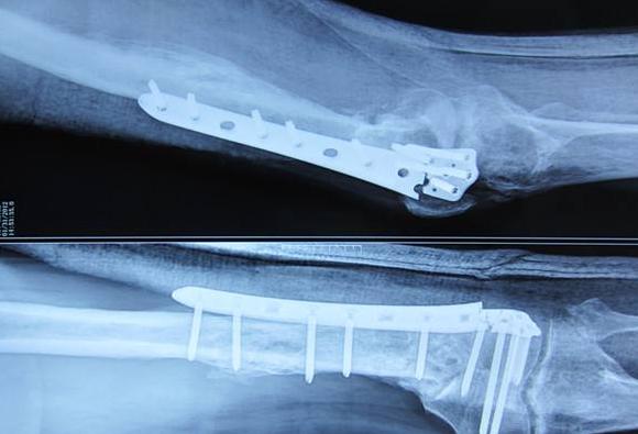 骨折不愈合的诊断标准,骨折伤口不愈合怎么办