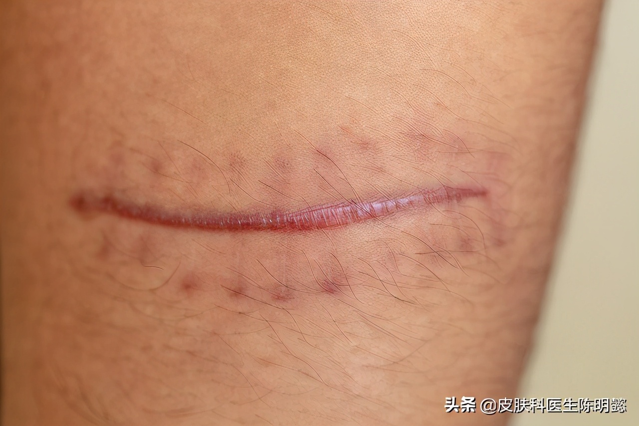 术后瘢痕特别大怎么处置,术后瘢痕形成的原因