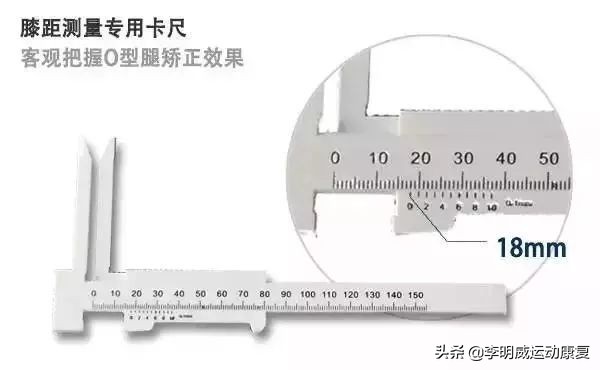 o型腿的自我鉴别及矫正方法,怎么知道o型腿是不是在慢慢变好