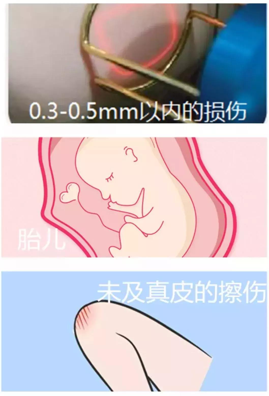 瘢痕体质如果要动手术怎么办,不太严重的疤痕体质能做手术吗