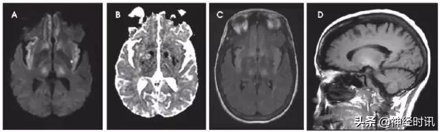 脑卒中病历诊断书图片,脑卒中影像判断技巧图解电子版