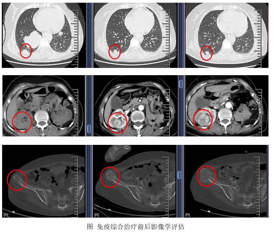 免疫治疗肾透明细胞癌有效吗,肾透明细胞癌肺转移靶向药