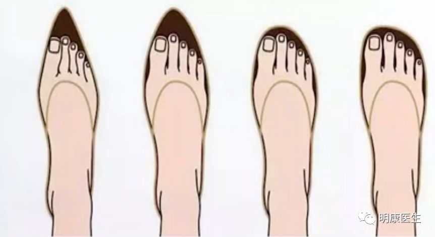 拇外翻治疗视频大全,治疗拇外翻最好医院