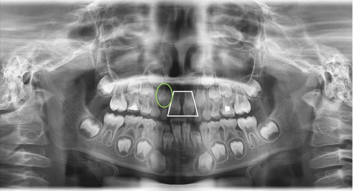 小孩牙缝太大需要看牙医吗,7岁小孩牙缝大了还能长吗