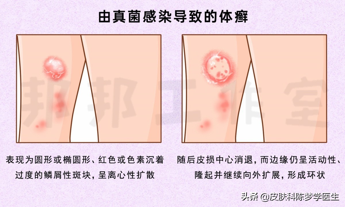 皮肤上的红斑可能是牛皮癣吗,红斑和脱屑的牛皮癣