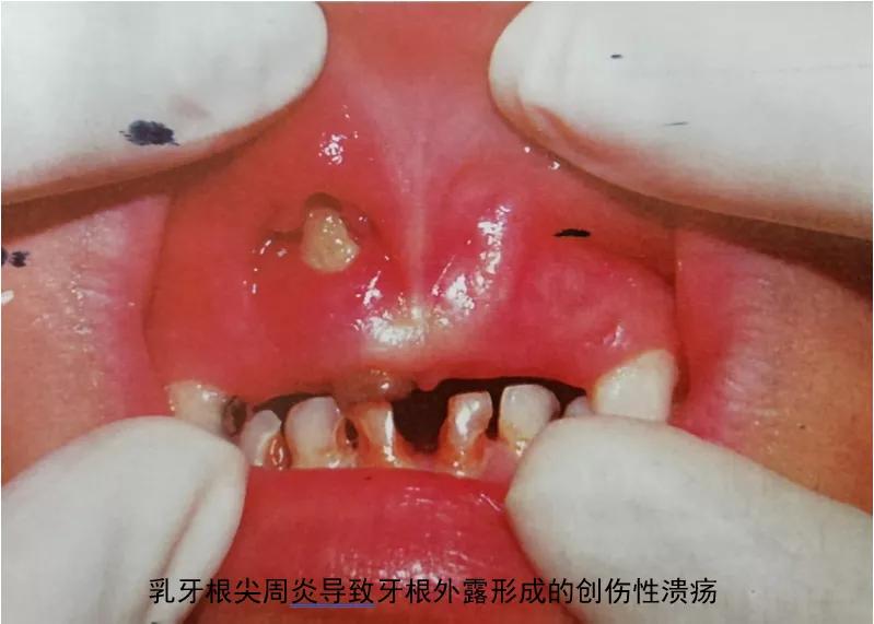 7岁宝宝嘴唇溃疡一大片，原因竟然是这个！#雅悦齿科#