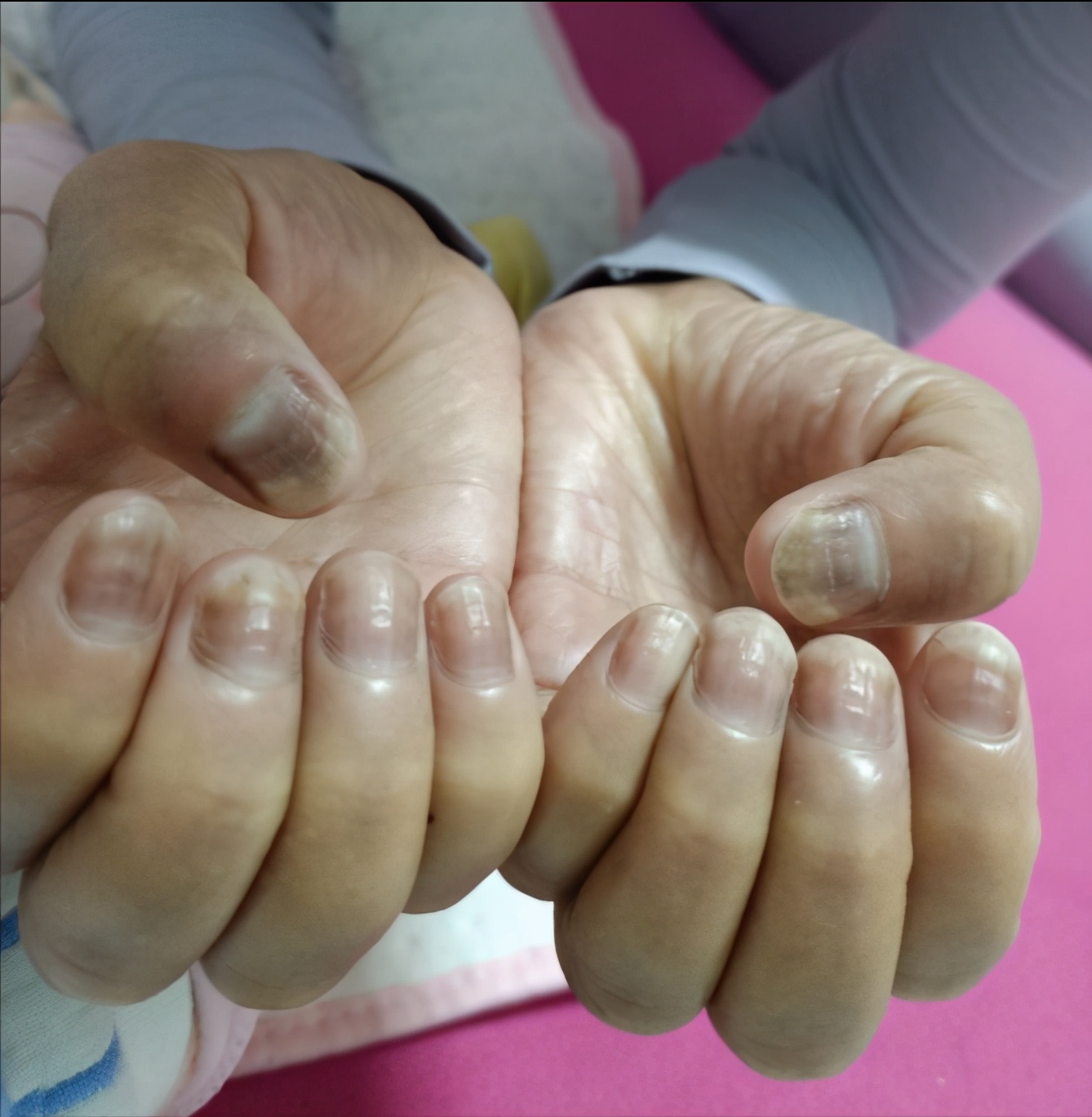 我得三阴乳腺癌的日子，治疗过程记录