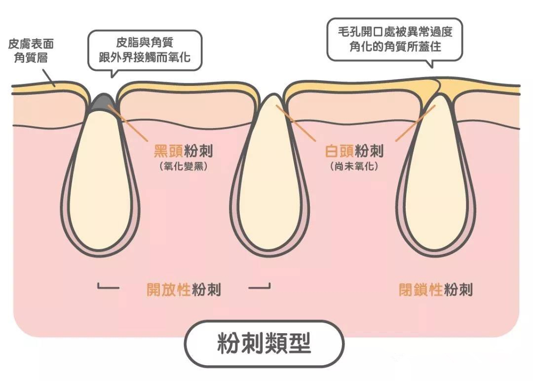 护肤为什么会长闭口,护肤为何毛孔变大脱皮