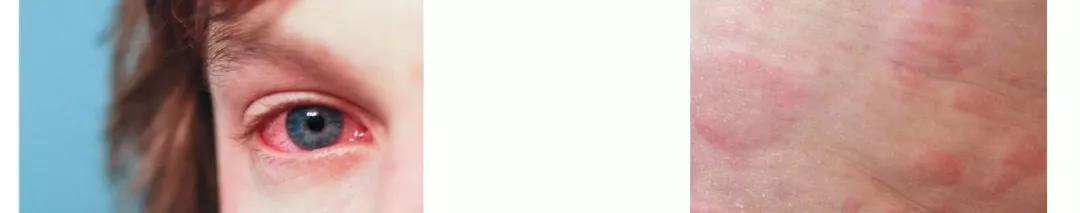 我对猫咪过敏挂啥科,人对猫咪过敏的症状