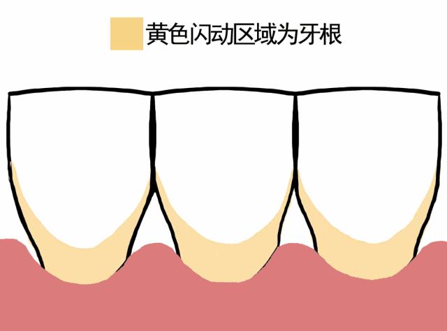 牙龈里的黑东西是什么,牙龈间有黑东西怎么办