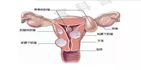 最靠谱的治疗子宫肌瘤,陈文直医生怎么样