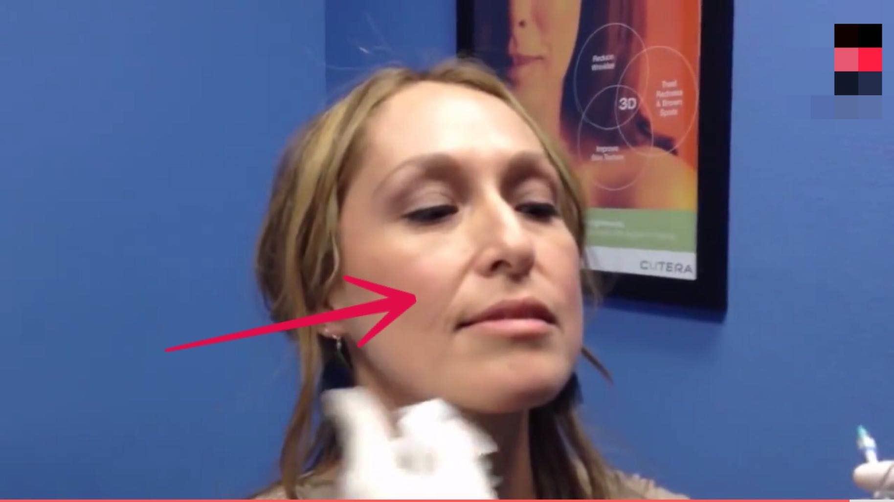 79岁英国一富婆为“除皱”，连打30年玻尿酸抗老，如今长啥样了？