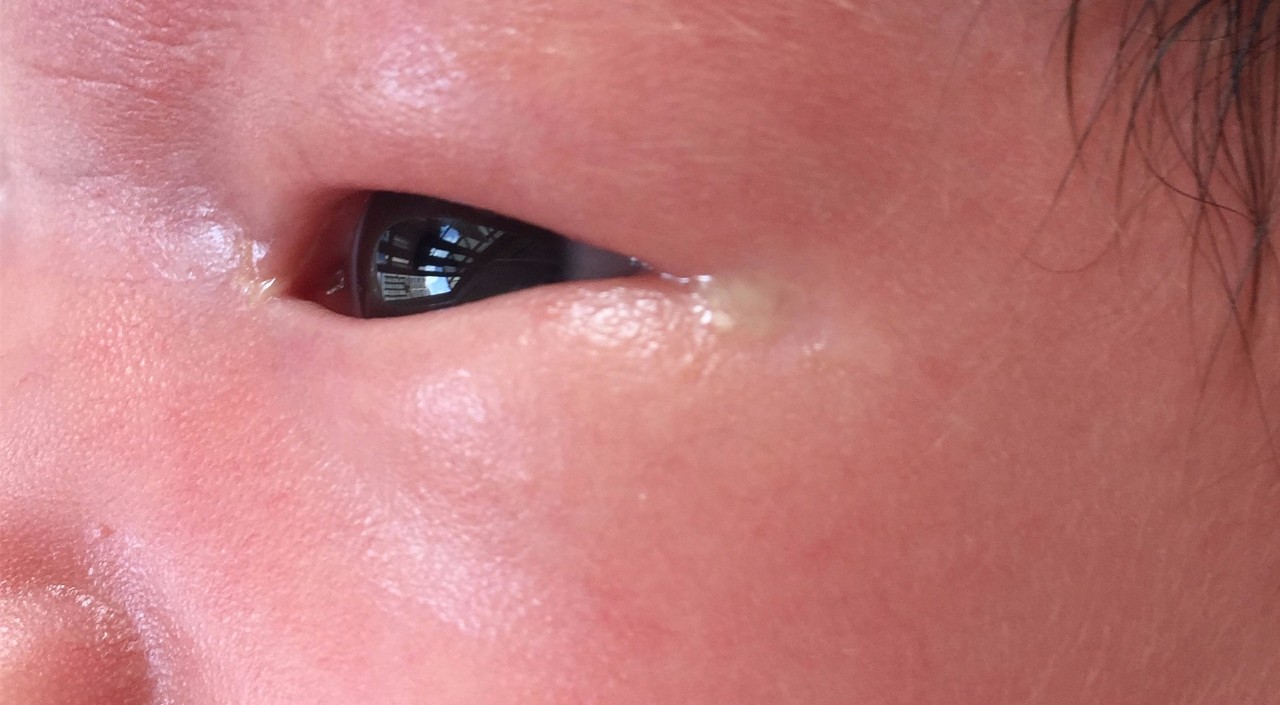 新生宝宝眼屎多什么原因,新生宝宝眼屎黄脓状怎么办